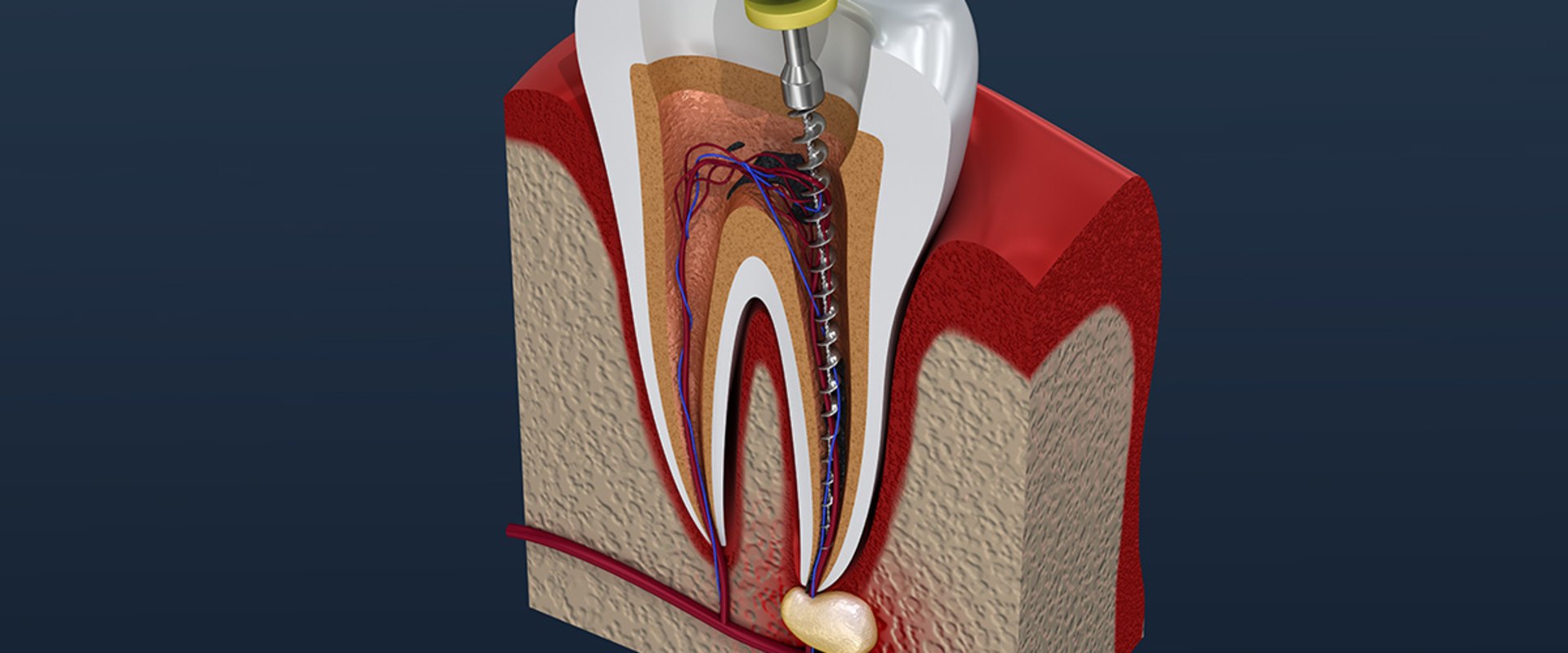 pain-after-root-canal-what-to-do-youtube